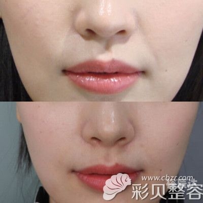 徐海星整容前后徐海星整容前后对比-第3张图片